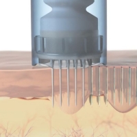 Mezoterapia mikroigłowa