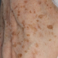 Laserowe usuwanie przebarwień