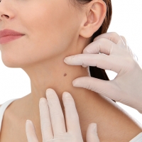 Usuwanie włókniaków